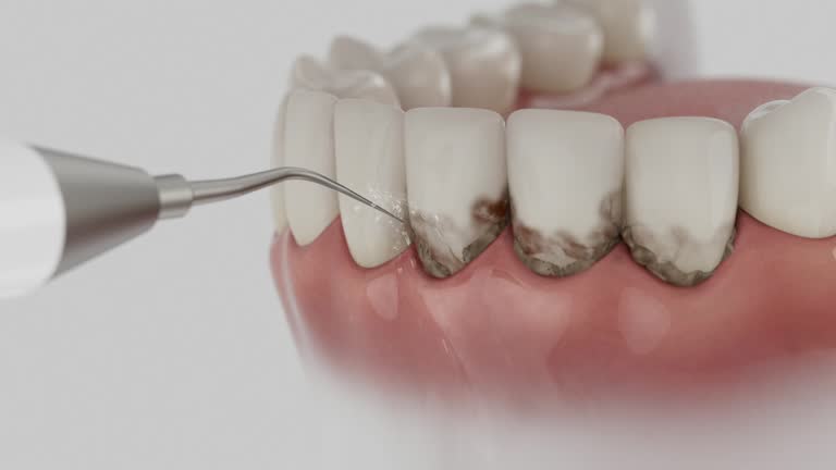 Trusted Wisdom Tooth Removal service in Milan, MO - Dentist Open Now